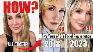 Five Years of DIY Facial Rejuvenation // All the details!