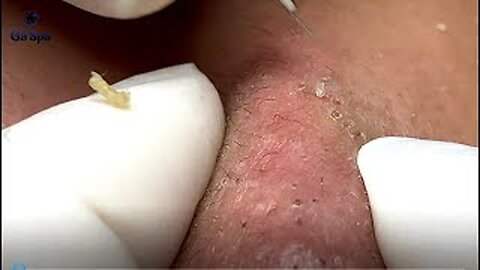 If You Like Squeezing Acnes, You'll : Must be See This Video Pimple Popper