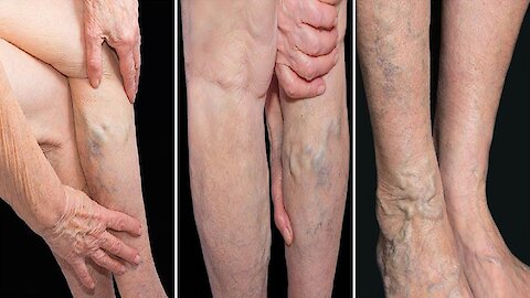 5 Reasons You Get Varicose Veins And How to Avoid It