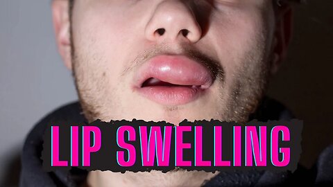 CAUSES OF SWOLLEN LIPS AND HOW TO TREAT