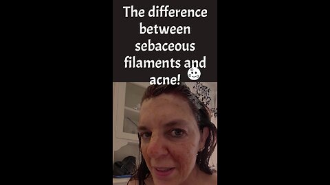 Acne vs. Sebaceous Filaments vs Blackhead The Difference?