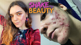 My Acne Is So Bad I Avoided Mirrors | SHAKE MY BEAUTY