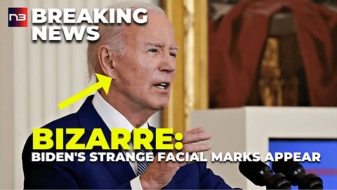 Decoded: Biden's Facial Markings Reveal Hidden Health Battle