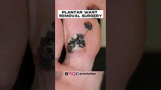 WOW! HUGE FOOT WART EVER??? ***PLANTAR WART REMOVAL SURGERY***