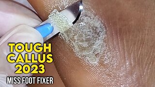 LARGE CALLOUS SHAVING 2023 | CALLUS SHAVING FROM SIDE OF THE FEET ( SATISFYING) BY MISS FOOT FIXER