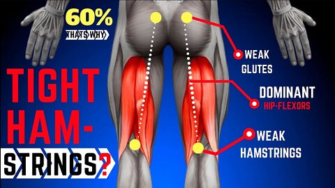 Why Your Hamstrings Are Always Tight | Anterior Pelvic Tilt