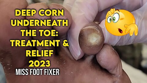 Extreme deep removal of Deep Corn Underneath the Toe: Treatment and Relief by miss foot fixer