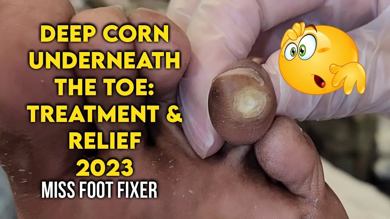 Extreme deep removal of Deep Corn Underneath the Toe: Treatment and Relief  by miss foot fixer