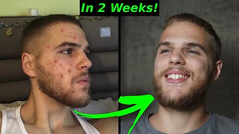 The 4 Tips That ELIMINATED My Acne and Cleared My Skin (As a Man)