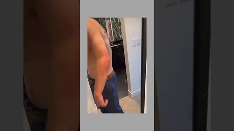 Cory Sandhagen displays his elbow injury. #shorts