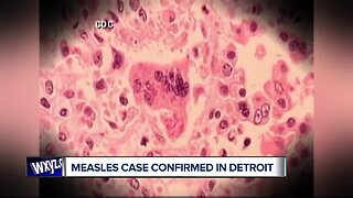 Measles confirmed in Detroit resident who returned from overseas travel