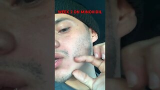 WEEK 2 MINOXIDIL #shorts