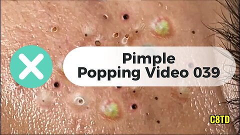 Satisfying Pimple Popping Videos 039