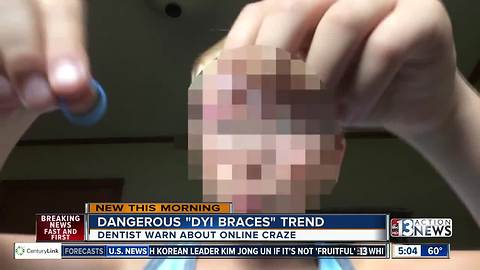 Dentists warn of using hairties and fishing wire to create own braces