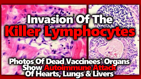 Vaccinee Autopsies: Killer Lymphocytes Invade Vital Organs, Drs Sucharit Bhakdi & Michael Palmer