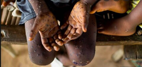 Monkeypox Virus: All You Need To Know 2022!