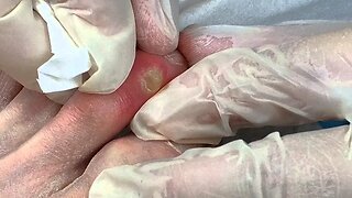 Drainage of an Infected Ganglion Cyst