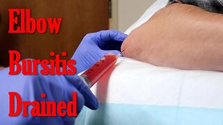 Swollen Elbow Drained | Olecranon Bursitis Aspirated