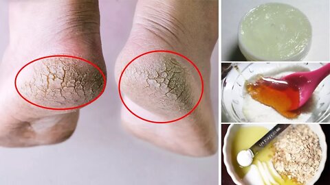How to Get Rid of Dry Feet and Cracked Heels Fast