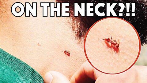 NECK STUNG BY A FIRE ANT!
