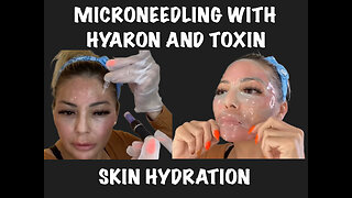 First Time Microneedling with Hyaron and Toxin