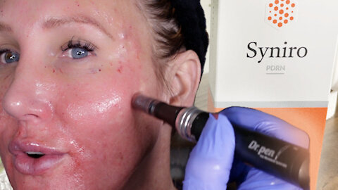 Syniro PDRN Microneedling | Gorgeously Aging