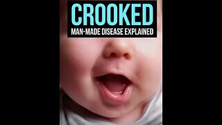 Vaccines-Heavy-Metals-Lopsided Faces-Eyes-Man Made Disease Explained