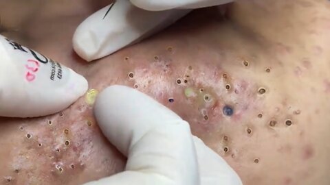 Removing Acne and Blackheads Treatment, #39