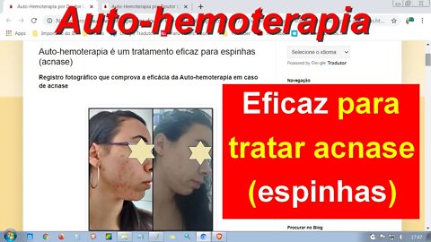 Auto-hemoterapia é um tratamento eficaz para espinhas (acnase). E proporcionou a melhora de rinite