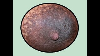 79. Nipples & Skin Disorders