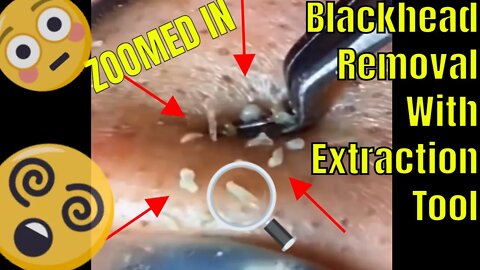 Zoomed in blackhead removal with extraction tool 🔍🪱 #blackheadremoval #blackhead #blackheads #fyp