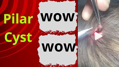 10 Year Pilar Cyst How Satisfying is this Pilar Cyst Removal Pilar Cyst Party