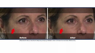 Reduce the signs of aging with Plexaderm