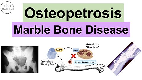 Osteopetrosis (Marble Bone Disease) | Causes, Symptoms, Diagnosis, Treatment