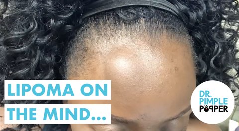 A Lipoma on the Mind... with Dr Pimple Popper