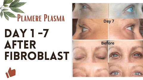 Day 1 -7 after Fibroblast Treatment with the Plamere Plasma Pen