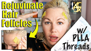 Rejuvinate Hair follicles with PLLA Threads (Grow new hair) | Code Jessica10 Saves you Money!