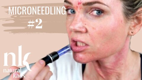 Microneedling at Home Session #2