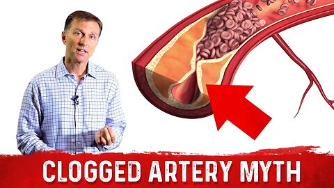 The Clogged Artery Myth – Dr. Berg