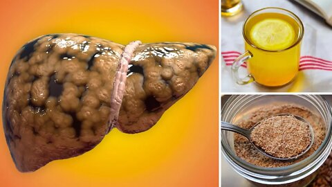 How to Treat Fatty Liver Disease Naturally at Home