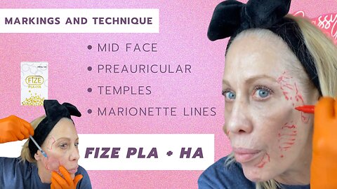 Fize PLA + HA to Restore Lower Face - Markings & Technique