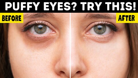 Get Rid of Puffy Eyes With Natural Remedies