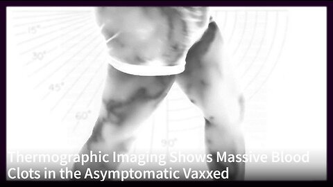 Thermographic Imaging Shows Massive Blood Clots in the Asymptomatic Vaxxed