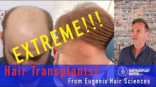 Extreme Cases of Hair Loss Turned Around