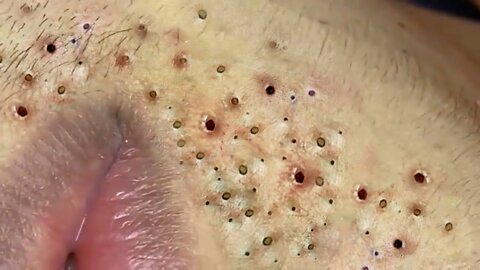 Blackheads Blackhead Removal Acne Extraction Relaxing #77