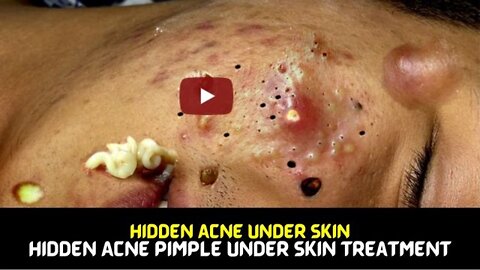 Hidden Acne Under Skin | Hidden Acne Pimple Under Skin Treatment