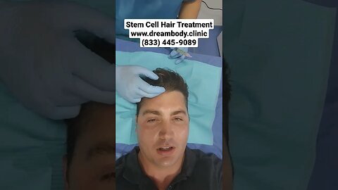 Stem Cell Hair Treatment with 20 million MSCs + Fibroblasts +PRP #preventbalding #hairloss #balding