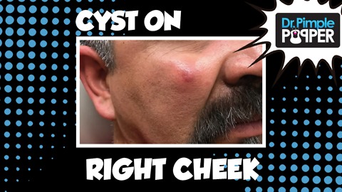 Cheek Cyst Albondiga! With Dr Pimple Popper
