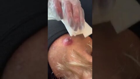 A BIG PIMPLE EXTRACTION