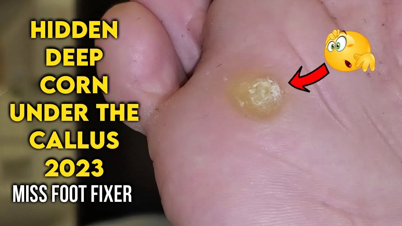 HIDDEN DEEP CORN UNDER THE CALLUS ON BOTTOM OF FOOT TREATMENT BY FAMOUS  PODIATRIST MISS FOOT FIXER